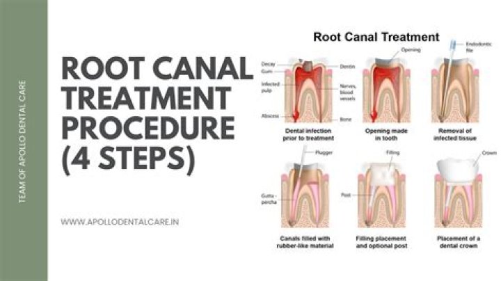 RCT Upper Molar: Comprehensive Guide to Root Canal Treatment for Upper Molars