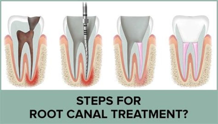 Root Canal Treatment for Top Molar: Everything You Need to Know