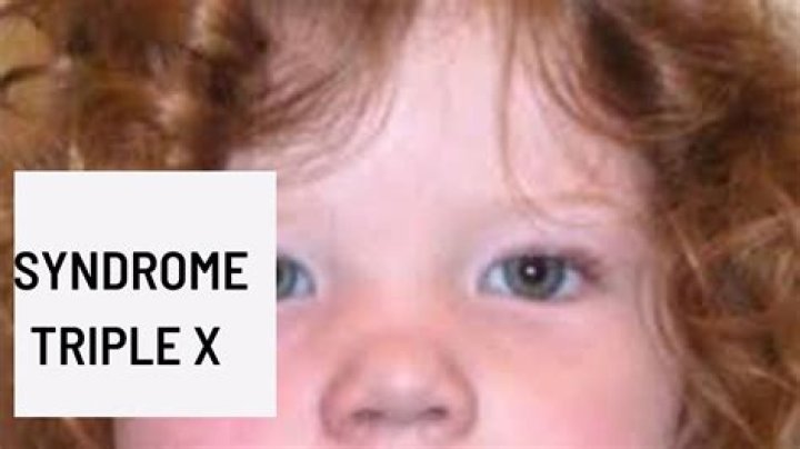 Triple X Syndrome Celebrities: Unveiling the Hidden Truth